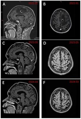 Case report: Long-term intracranial effect of zimberelimab monotherapy following surgical resection of high PD-L1-expressing brain metastases from NSCLC